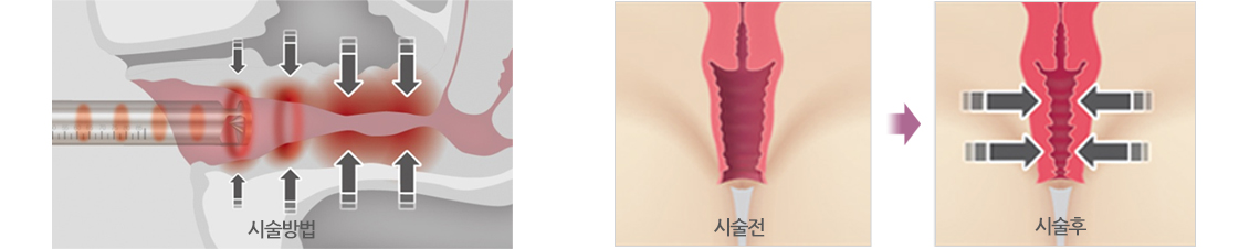 레이저를 이용한 360º 질 타이트닝 시술 방법과 효과